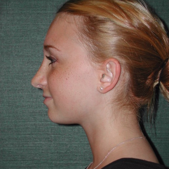 17 or under year old woman treated with Rhinoplasty after 3205311