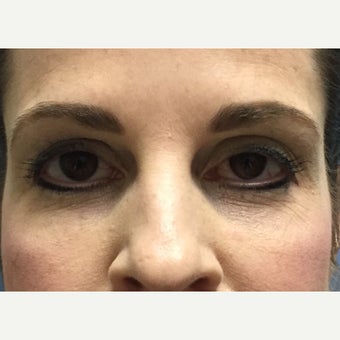 45-54 year old woman treated with Restylane after 2050229