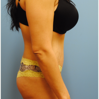 25-34 year old woman treated with Tummy Tuck after 3061549