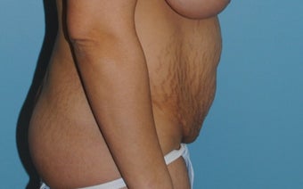 25-34 year old woman treated with Tummy Tuck before 3061549