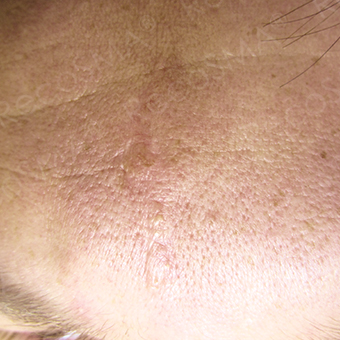 35 year old woman, scar treatment with RecoSMA after 3499222