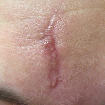 35 year old woman, scar treatment with RecoSMA before 3499222