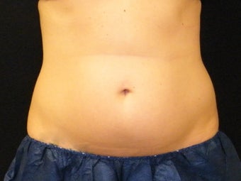 CoolSculpting before 1131275