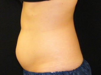 CoolSculpting 1131275