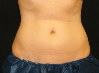 CoolSculpting after 1131275