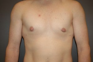 Bilateral keyhole approach. Incision limited to lower half of areola. Three month photo. 1130793