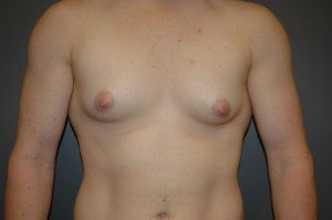 Bilateral keyhole approach. Incision limited to lower half of areola. Three month photo. 1130793