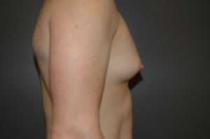 Bilateral keyhole approach. Incision limited to lower half of areola. Three month photo. before 1130793