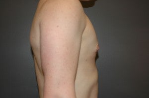 Bilateral keyhole approach. Incision limited to lower half of areola. Three month photo. after 1130793