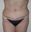 58 year old female patient after 911395
