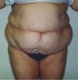 58 year old female patient before 911395