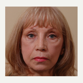 65-74 year old woman treated with Cheek Augmentation before 3749032