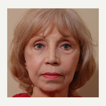 65-74 year old woman treated with Cheek Augmentation after 3749032