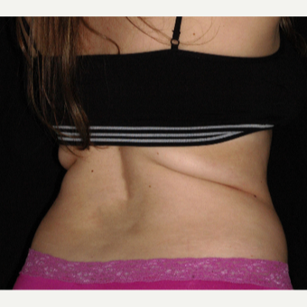 25-34 year old woman treated with SculpSure before 3541905