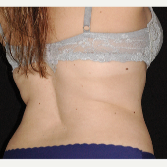 25-34 year old woman treated with SculpSure after 3541905