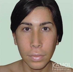 MTF Facial Feminization Surgery after 2704796