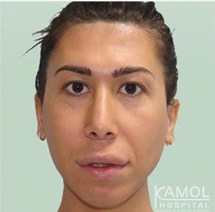 MTF Facial Feminization Surgery before 2704796