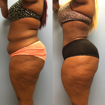 30 year old woman treated with Tummy Tuck and Lipo 360 after 3174751