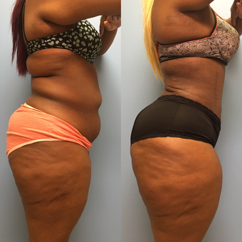 30 year old woman treated with Tummy Tuck and Lipo 360 before 3174751