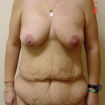 35-44 year old woman treated with Body Lift before 3261188