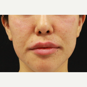 27 year old female treated with Juvederm for lip augmentation after 3104209