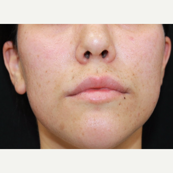 27 year old female treated with Juvederm for lip augmentation before 3104209
