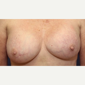 71 year old woman with a Breast Implant Revision before 3076197