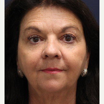55-64 year old woman treated with Smart Lipo Precision TX to lift and tighten the face after 3243309