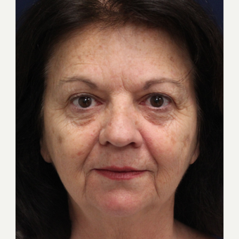 55-64 year old woman treated with Smart Lipo Precision TX to lift and tighten the face before 3243309