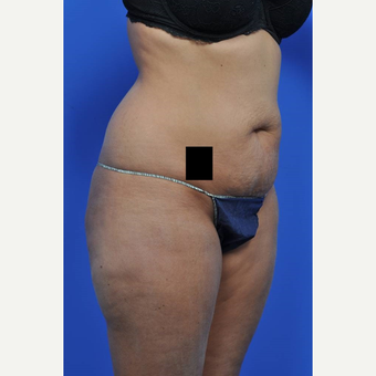 25-34 year old woman treated with Tummy Tuck before 3449713