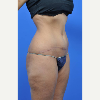 25-34 year old woman treated with Tummy Tuck after 3449713