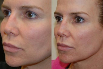 Permanent Lip Augmentation with Silikon-1000 before 1327194