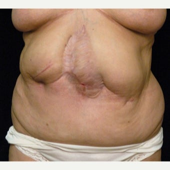 61 year old woman treated with Scar Revision before 1697997