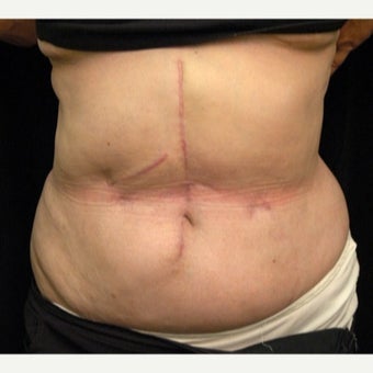 61 year old woman treated with Scar Revision after 1697997