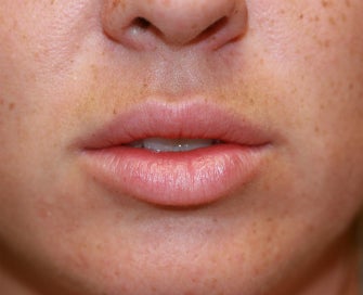 Silicone Lip Implants-Permanent Lip Augmentation before 1174487