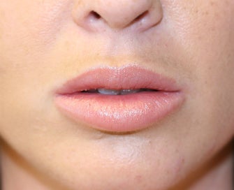 Silicone Lip Implants-Permanent Lip Augmentation after 1174487