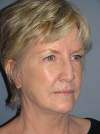 68 Year Old Female Following the Lite Lift™ 1114647