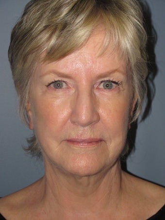 68 Year Old Female Following the Lite Lift™ after 1114647