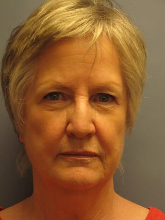 68 Year Old Female Following the Lite Lift™ before 1114647