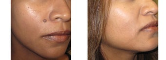 Mole Removal photos before 951882