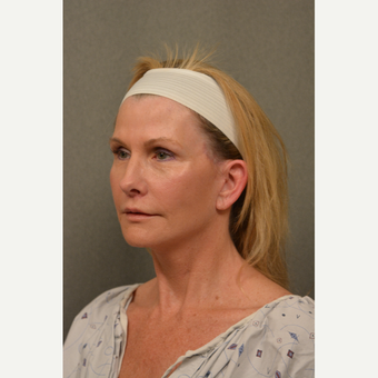 45-54 year old woman treated with Facelift after 3696363
