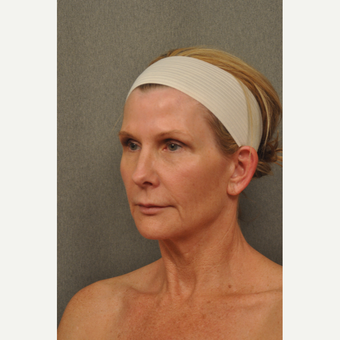 45-54 year old woman treated with Facelift before 3696363