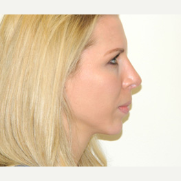 25-34 year old woman treated with Rhinoplasty after 3371775