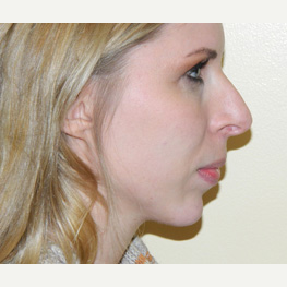 25-34 year old woman treated with Rhinoplasty before 3371775