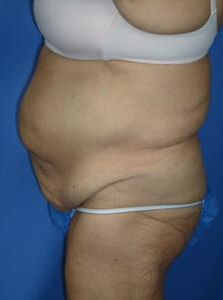 Circumferential Tuck before 863778