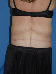Circumferential Tuck 863778