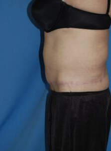 Circumferential Tuck after 863778