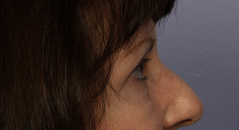 Eyelid Surgery 302504