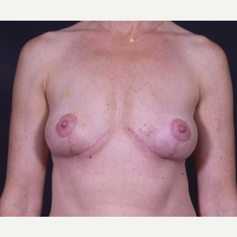 35-44 year old woman treated with Breast Implant Removal after 2839773