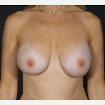 35-44 year old woman treated with Breast Implant Removal before 2839773